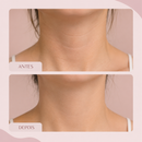 Adesivo de Silicone Anti Rugas Reutilizável Hadarea